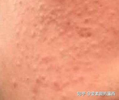 粉刺露真的可以祛粉刺吗 v2-bddb9bcbd2a318d4f3a3c90fd6d765b3_b.jpg