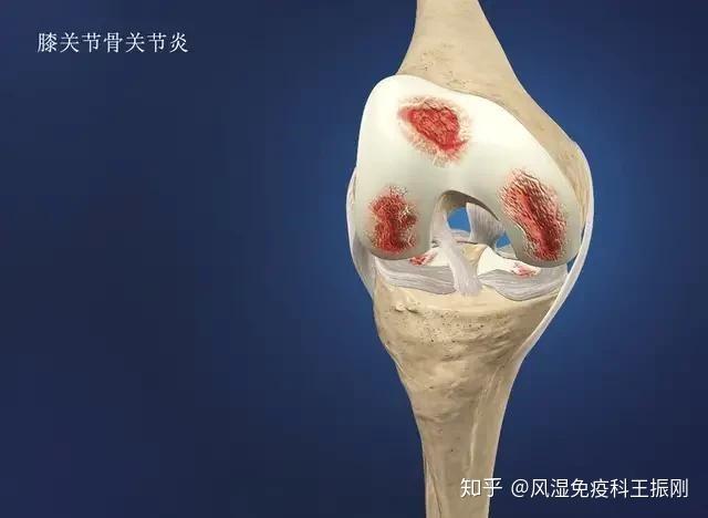 我们临床上通常通过x光将膝关节骨关节炎分成五个分期