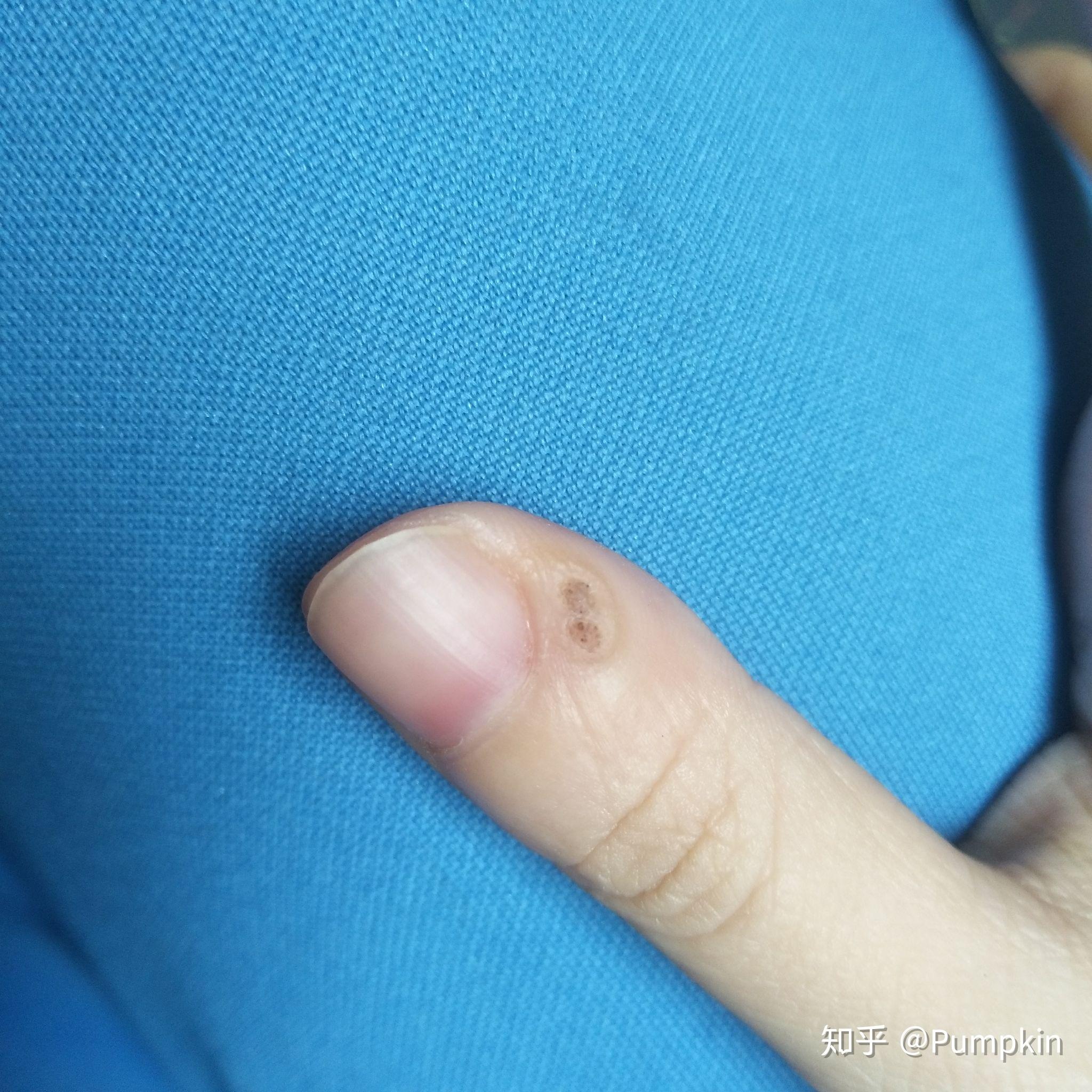 治疣全过程 - 知乎