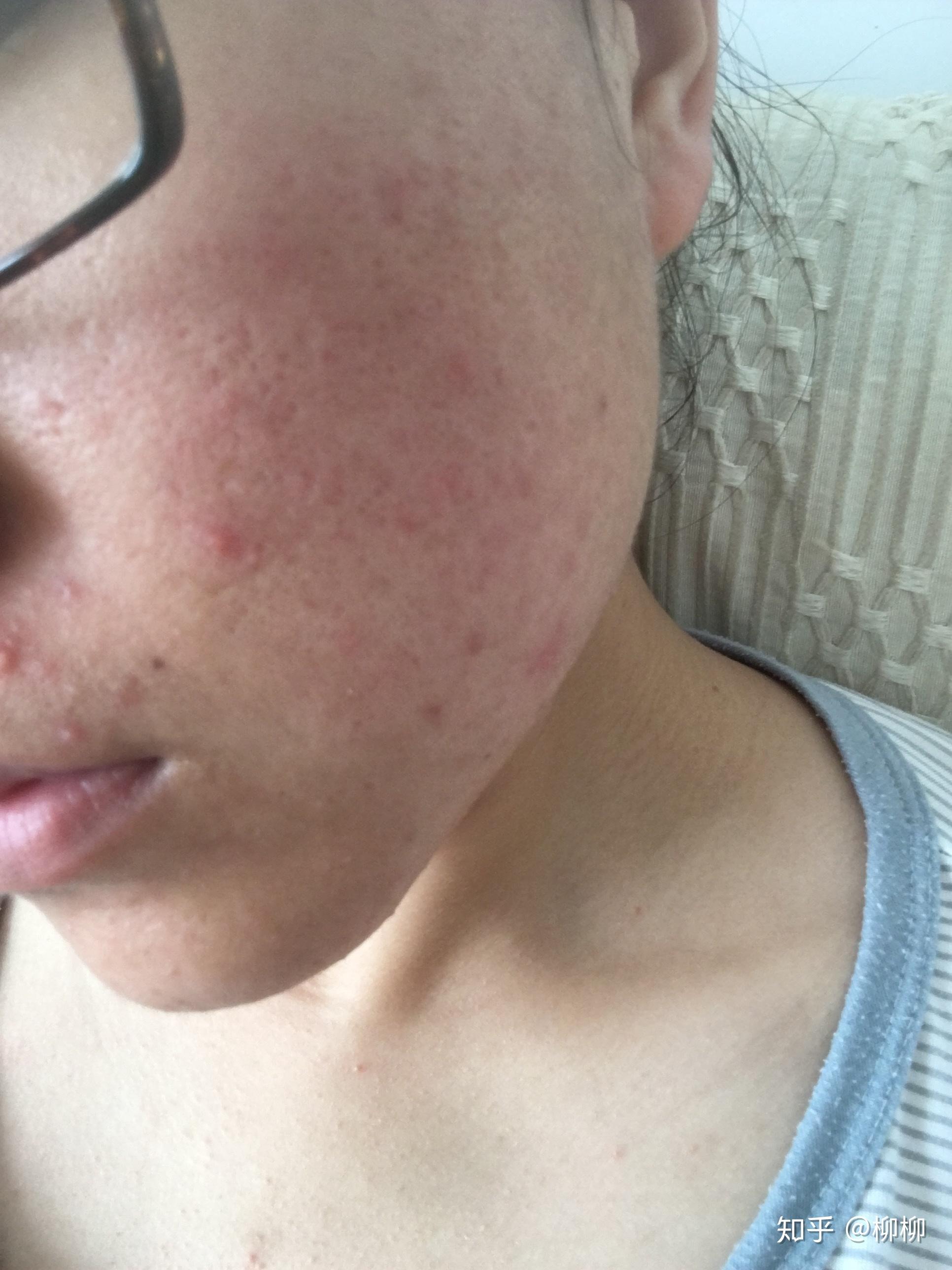 怎样去痘痘啊很自卑皮肤不好