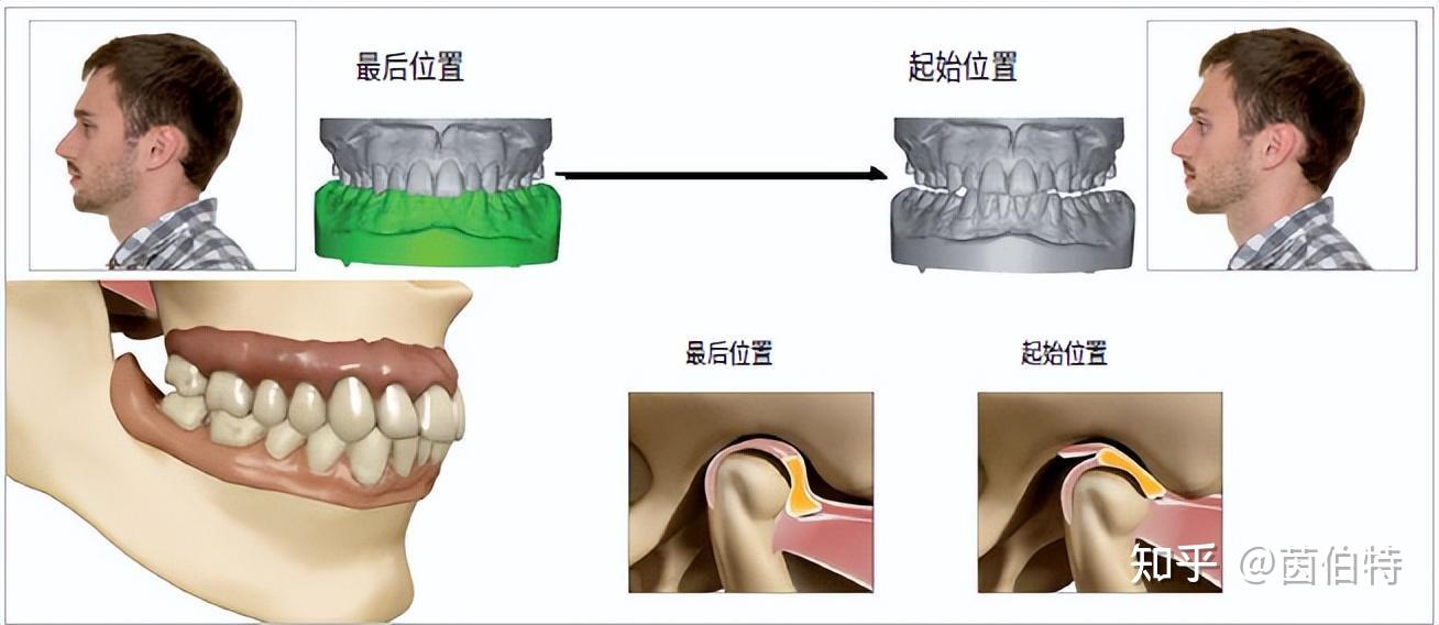 高效率的颌垫治疗---通过跨学科合作，恢复病人的全部功能 - 知乎