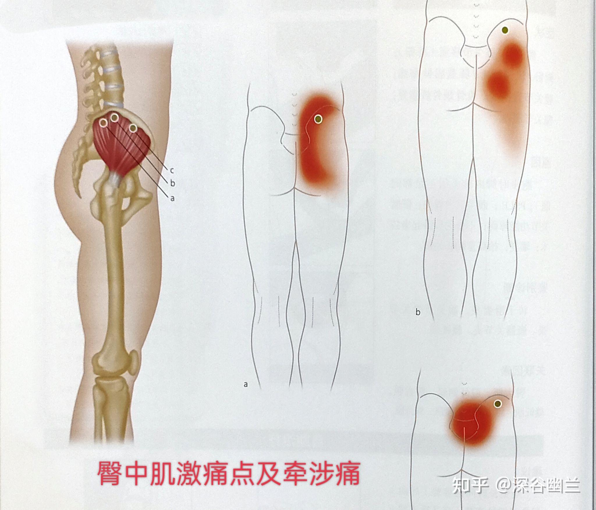 腰背部疼痛相关激痛点及穴位