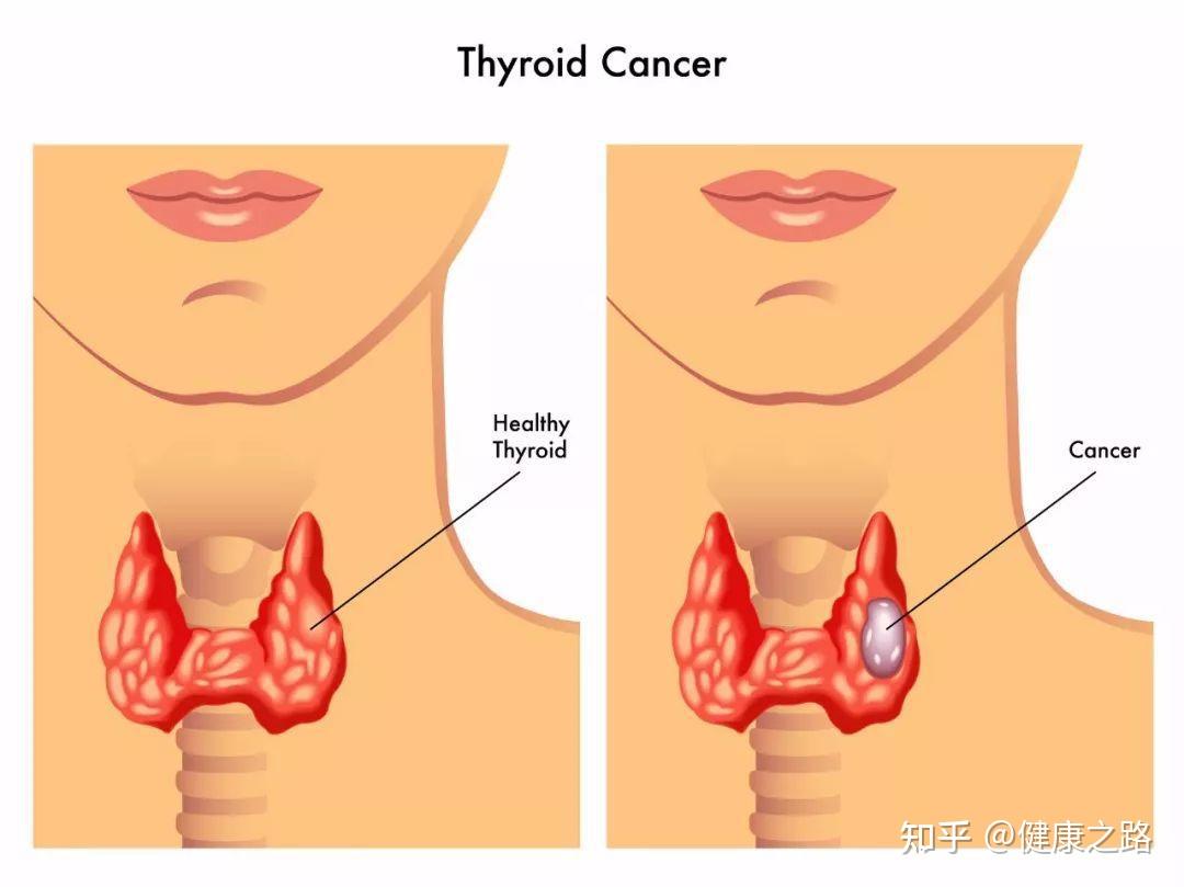 如何消除甲状腺结节 v2-be3c56f806e19895fd1c4df0594bea87_r.jpg