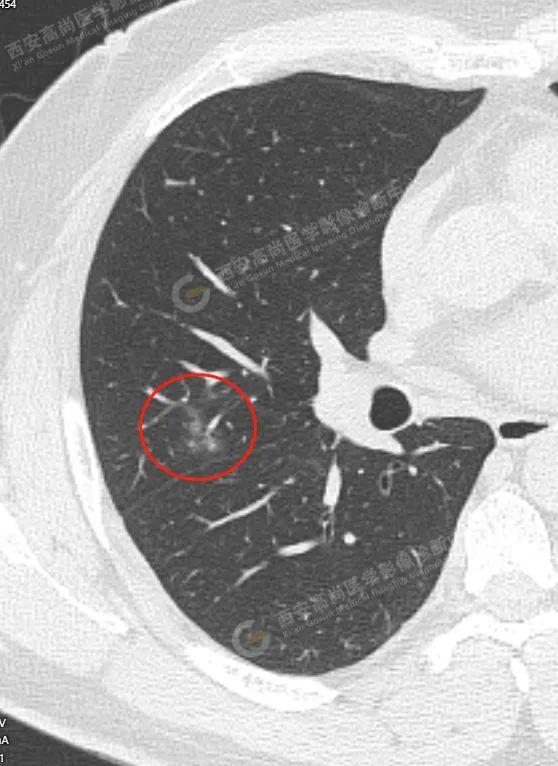 高尚病例 普通型新冠感染累及肺早期影像学表现