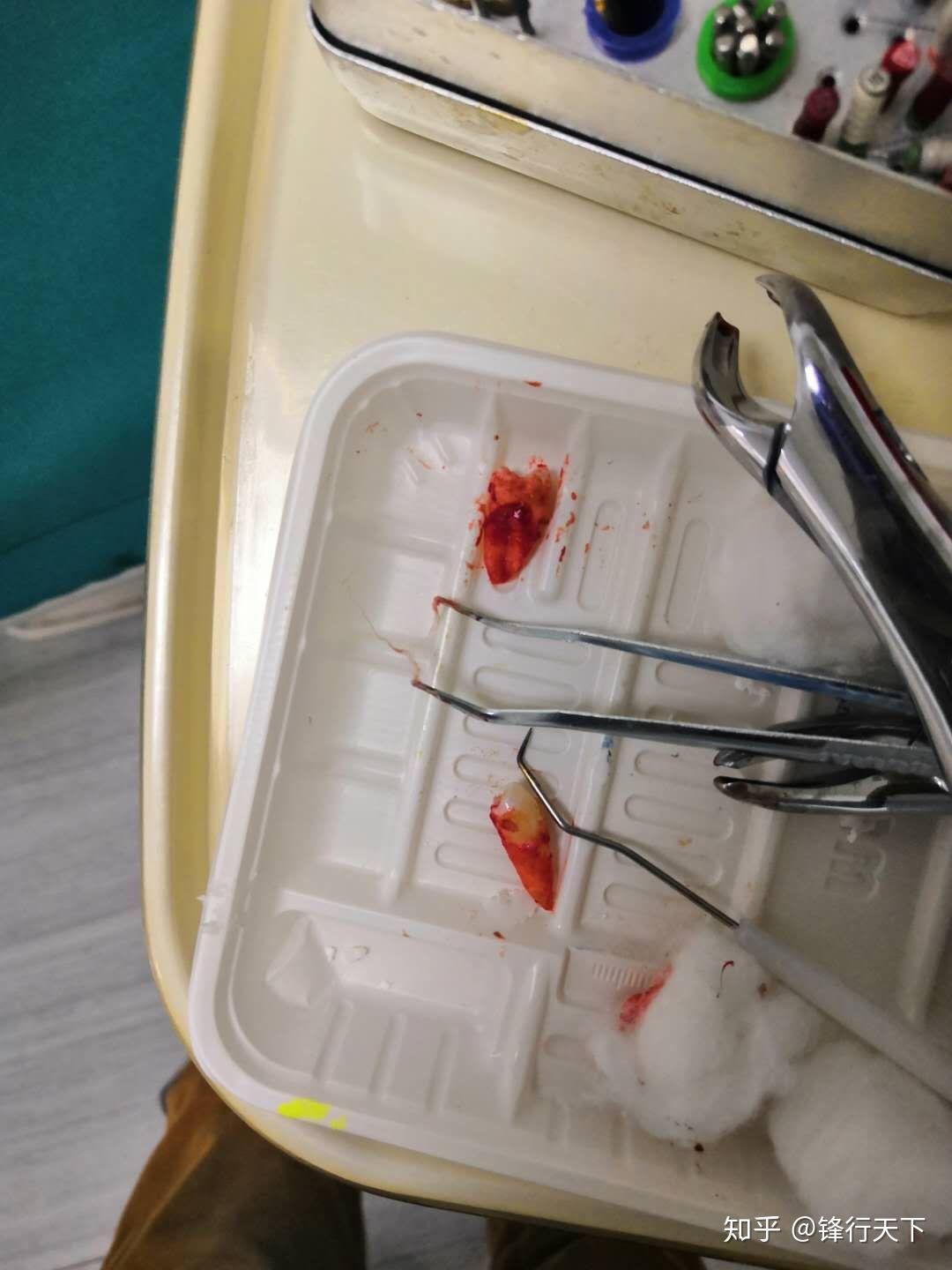 拔牙正畸 - 知乎