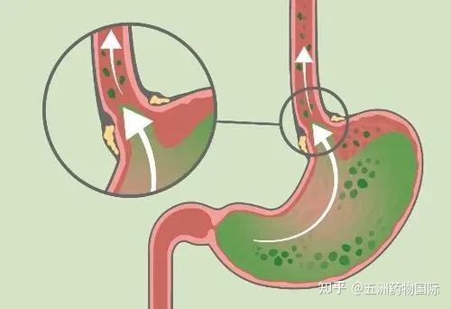 胃反酸要少吃的食物来看看有什么建议收藏