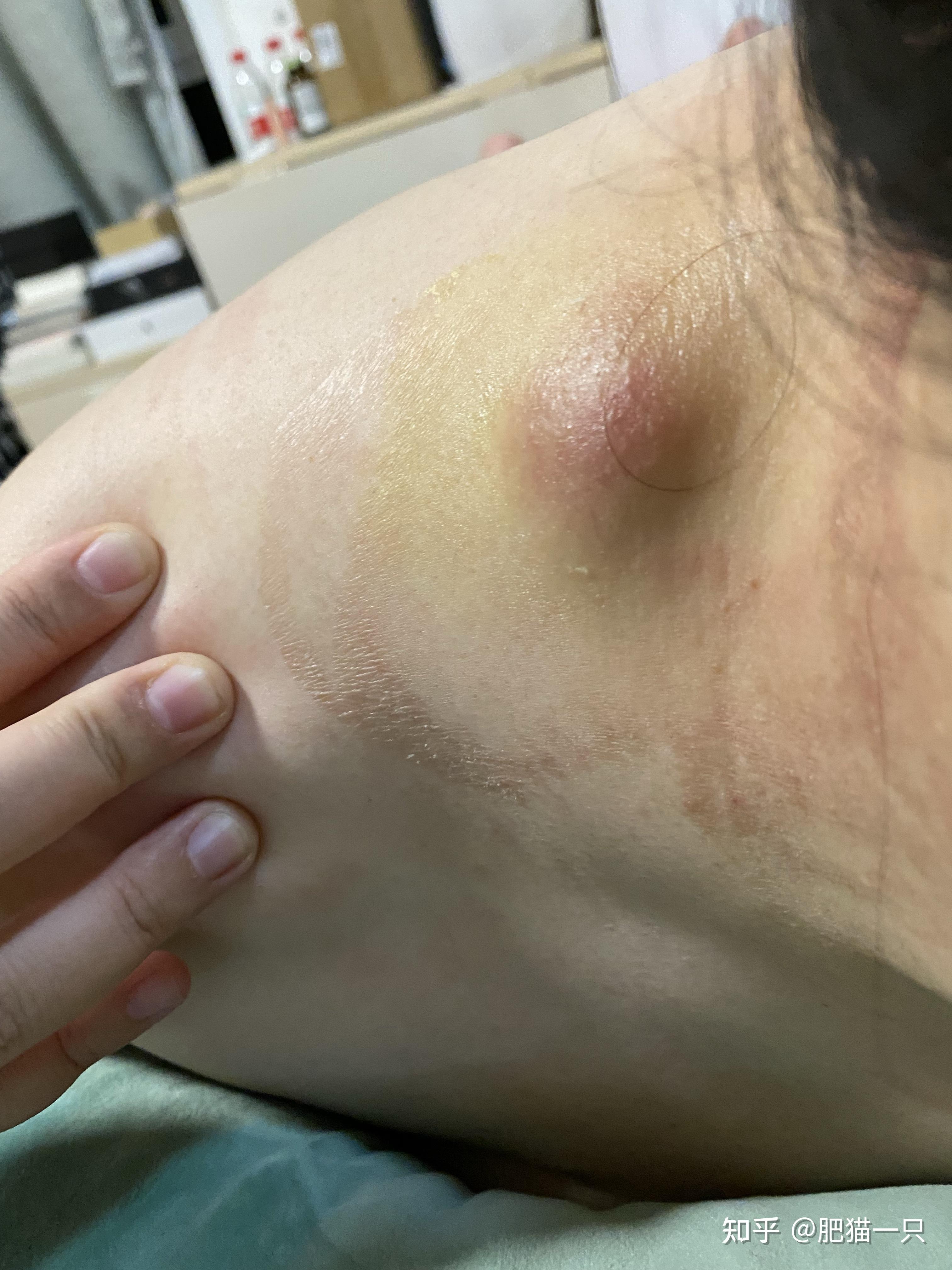 粉瘤到底是什么