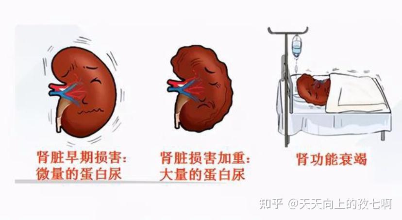 第二个糖尿病并发症为糖尿病肾病此外,糖尿病还可引起青光眼,白内障