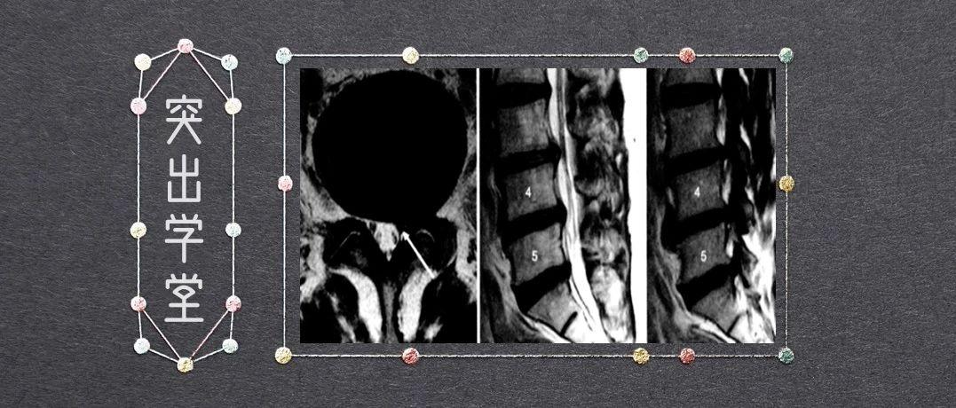 10分钟学会你自己也能看高深的腰椎间盘突出ct和mri磁共振片子建议