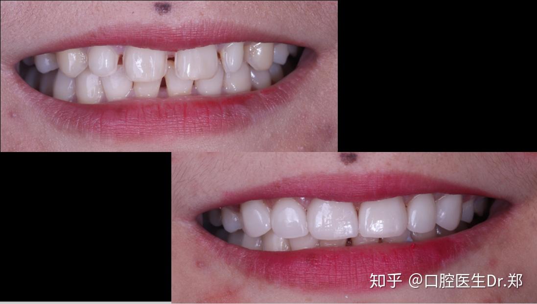 正畸过程中出现黑三角怎么办