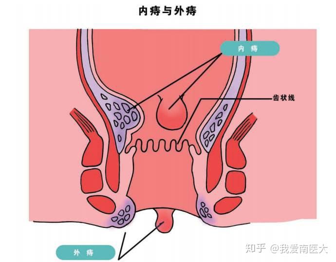 疖子的原理_疖子的图片(2)