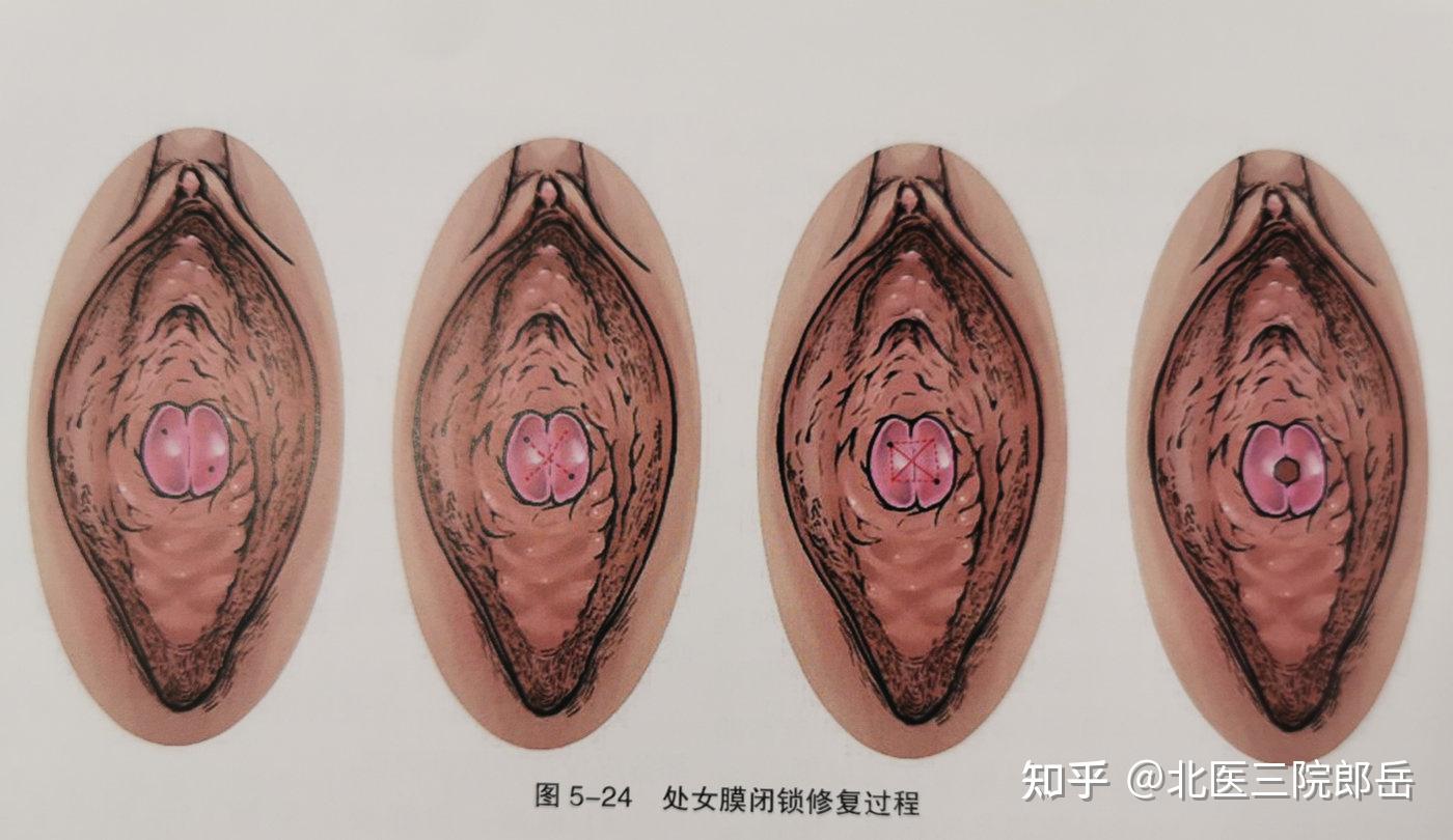 处女膜 