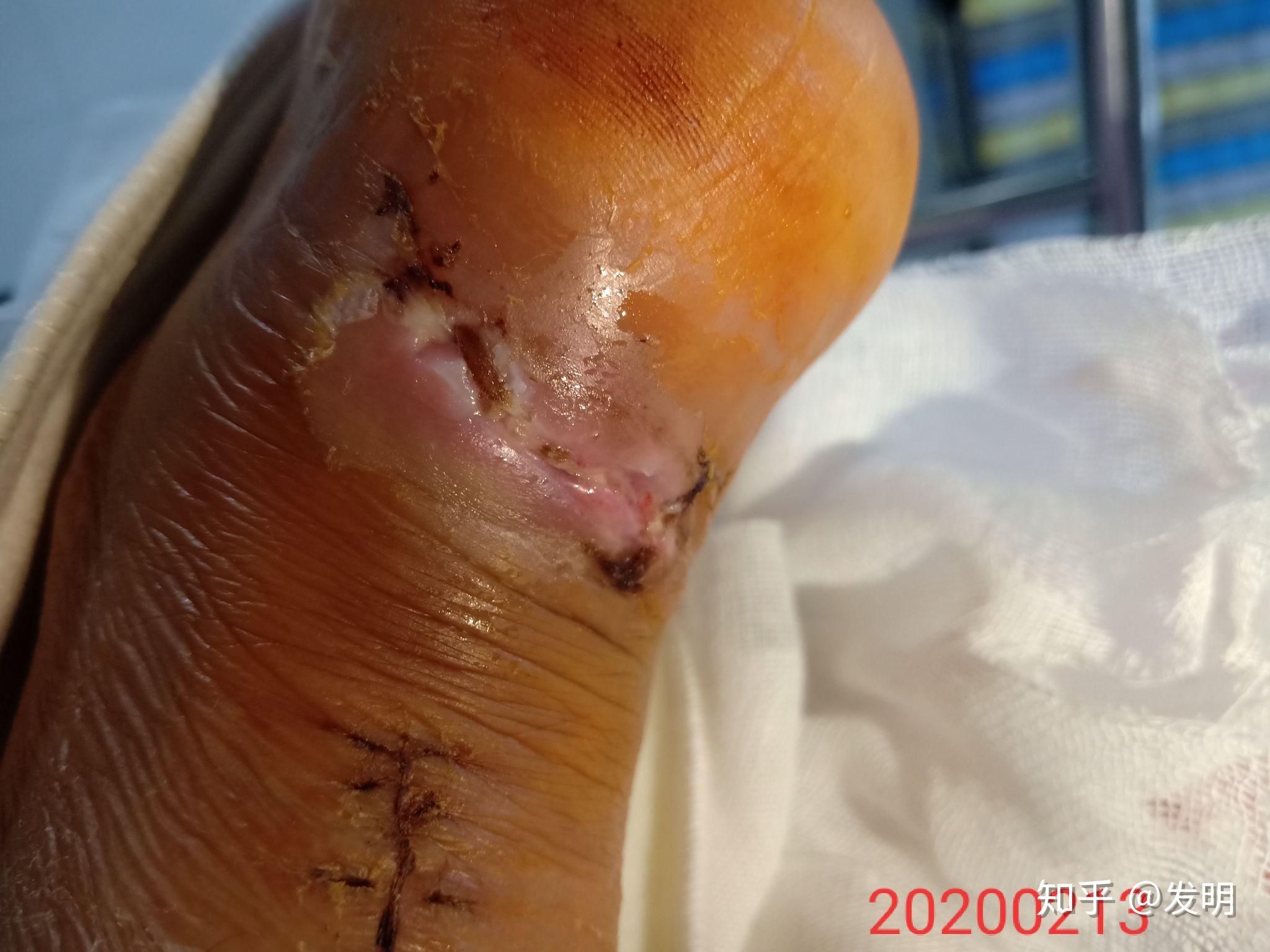 跟腱断裂 - 知乎