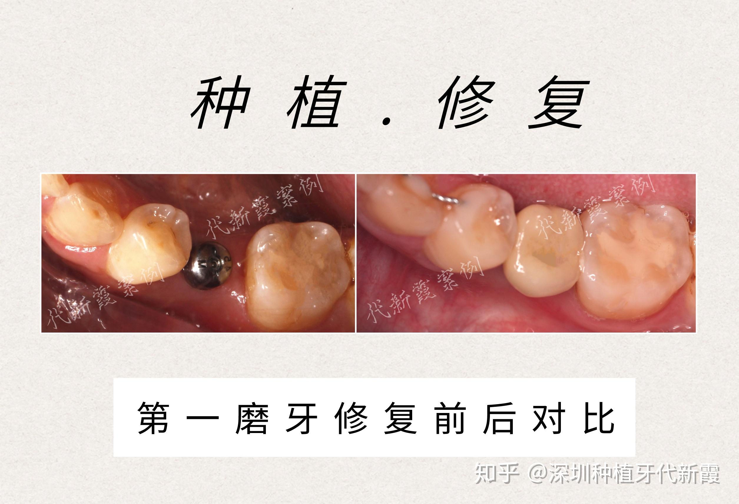 天生缺一颗门牙,牙齿乱长还不齐,有一颗磨牙因为得了蛀牙,小时候被拔掉了,这种情况该怎么办呢? - 知乎