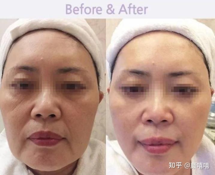 做线雕怕被坑埋线提升医院医生选择价格案例干货分析