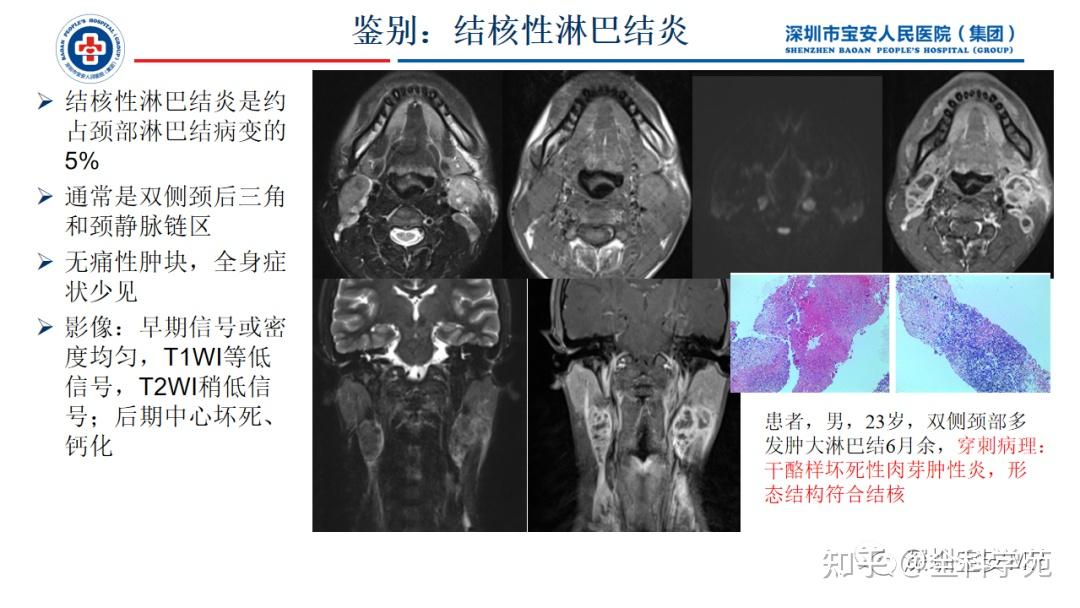 淋巴结转移 zhuanlan.zhihu.com