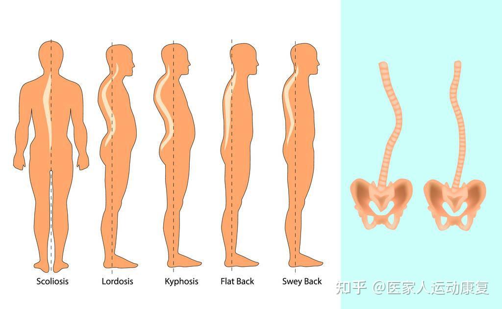 01,什麼是脊柱側彎有可能脊柱側彎正在威脅孩子的健康身體這種時候就