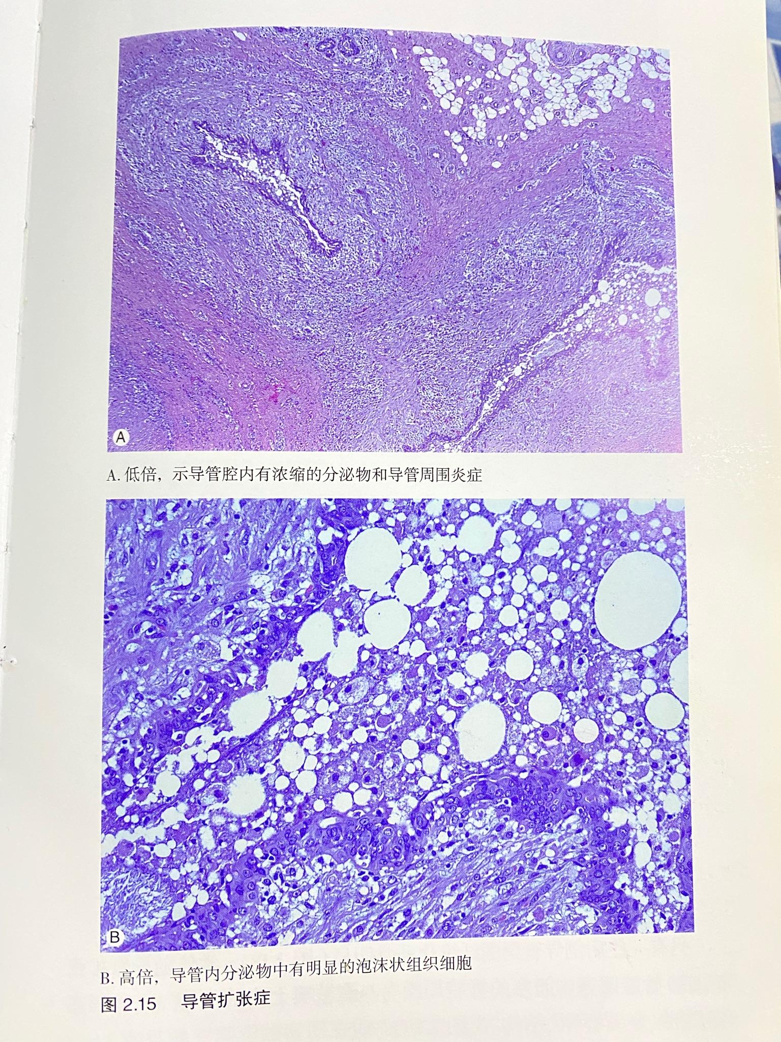 乳腺导管扩张症及其鉴别诊断