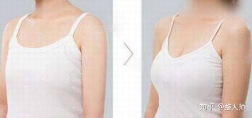什么是水滴状乳房 v2-beb0d87d10b51fb2038f3b486f46d28b_r.jpg