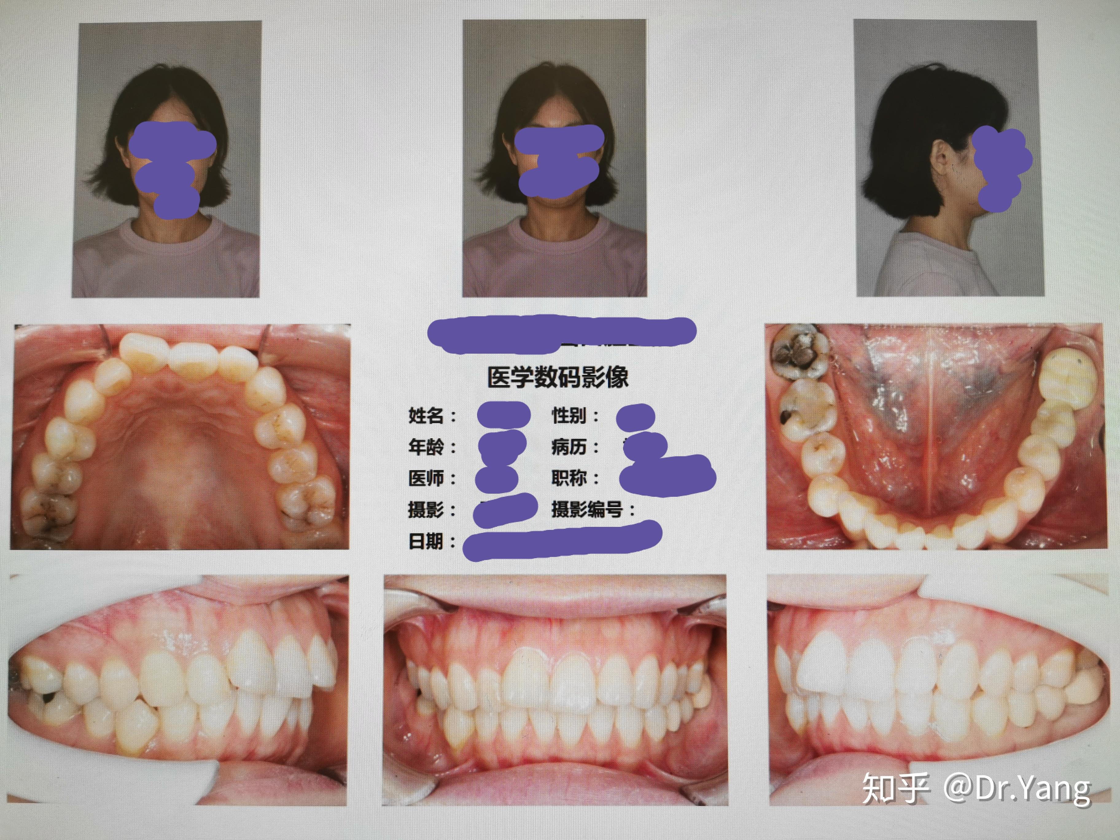 正畸前的常规检查项目