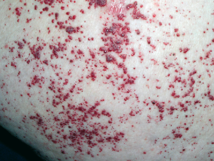 单基因遗传病之法布里病(fabrys disease)