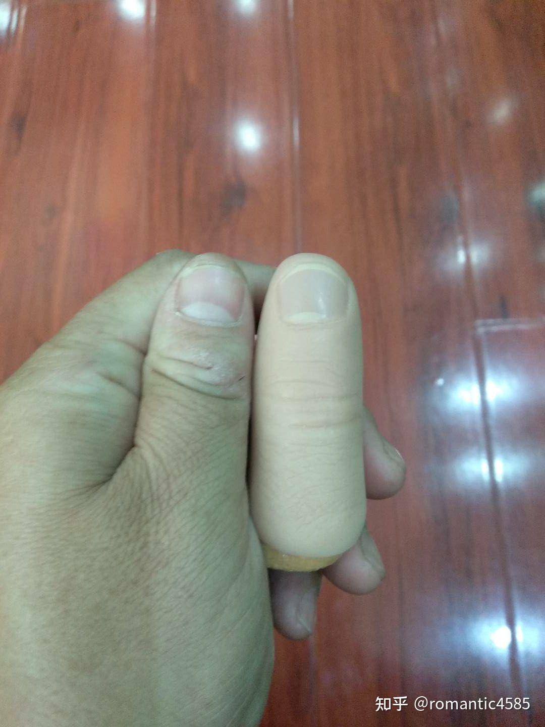 右手大拇指6级工伤图图片
