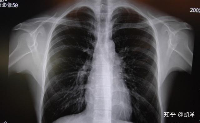 抽烟肺部x光片图片