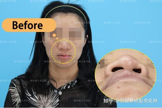 【唇裂鼻修复 案例分享】扁塌鼻变身“水滴鼻”,唇鼻畸形小姐姐很满意! - 知乎