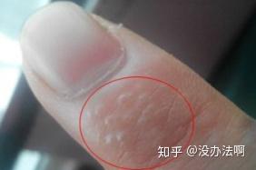 做到这几点 夏季汗疱疹远离你 知乎