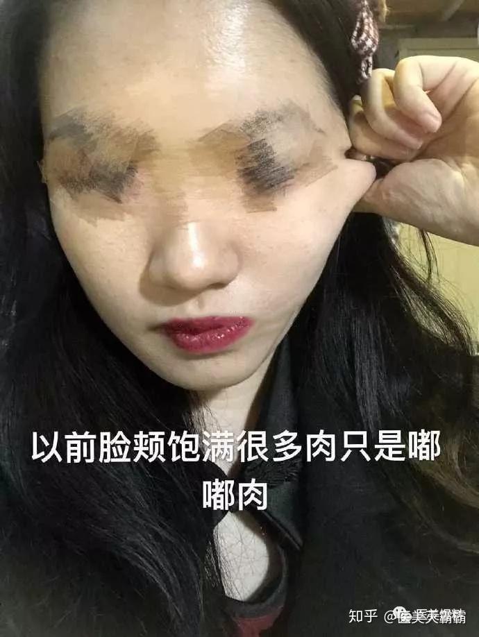 面颊严重松弛下垂皮肉分离面颊严重凹陷断层事情经过:手术前几天来到