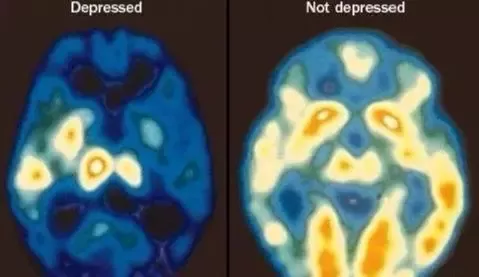 重度抑郁症大脑图片