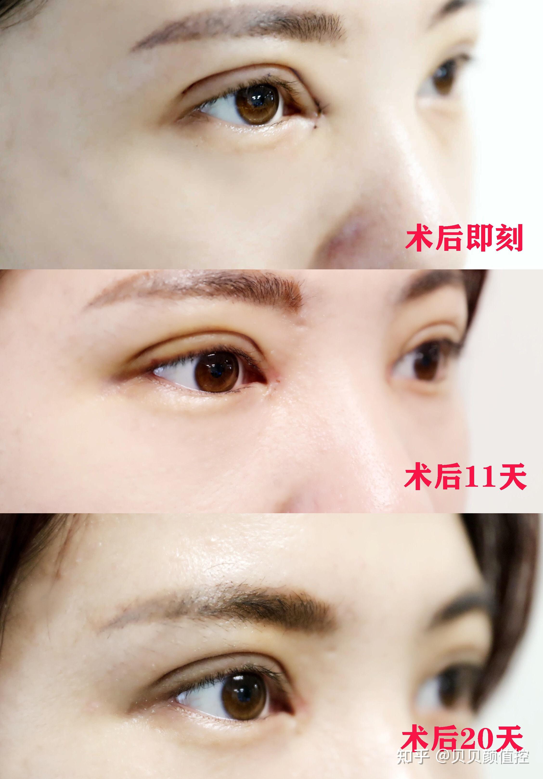 为什么眼综合被称为医美入圈项目