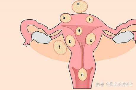 除此之外,因为子宫肌瘤主要是由子宫平滑肌细胞增生而成,这其中有少量