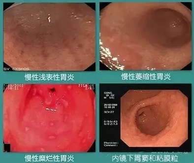 21歲女大學生查出胃癌晚期專家指出6類高危人群