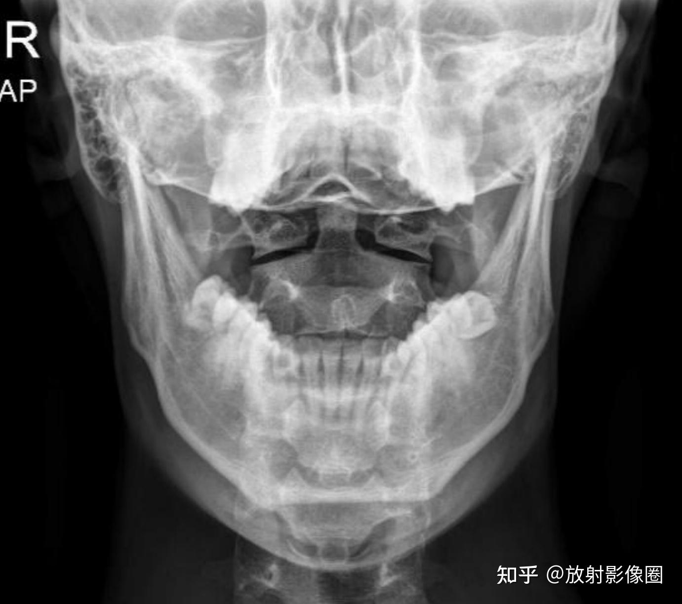 颈椎张口位摄片技巧与总结 - 知乎