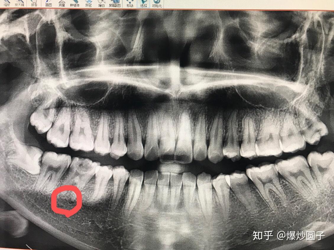 大牙牙根图片x光图图片