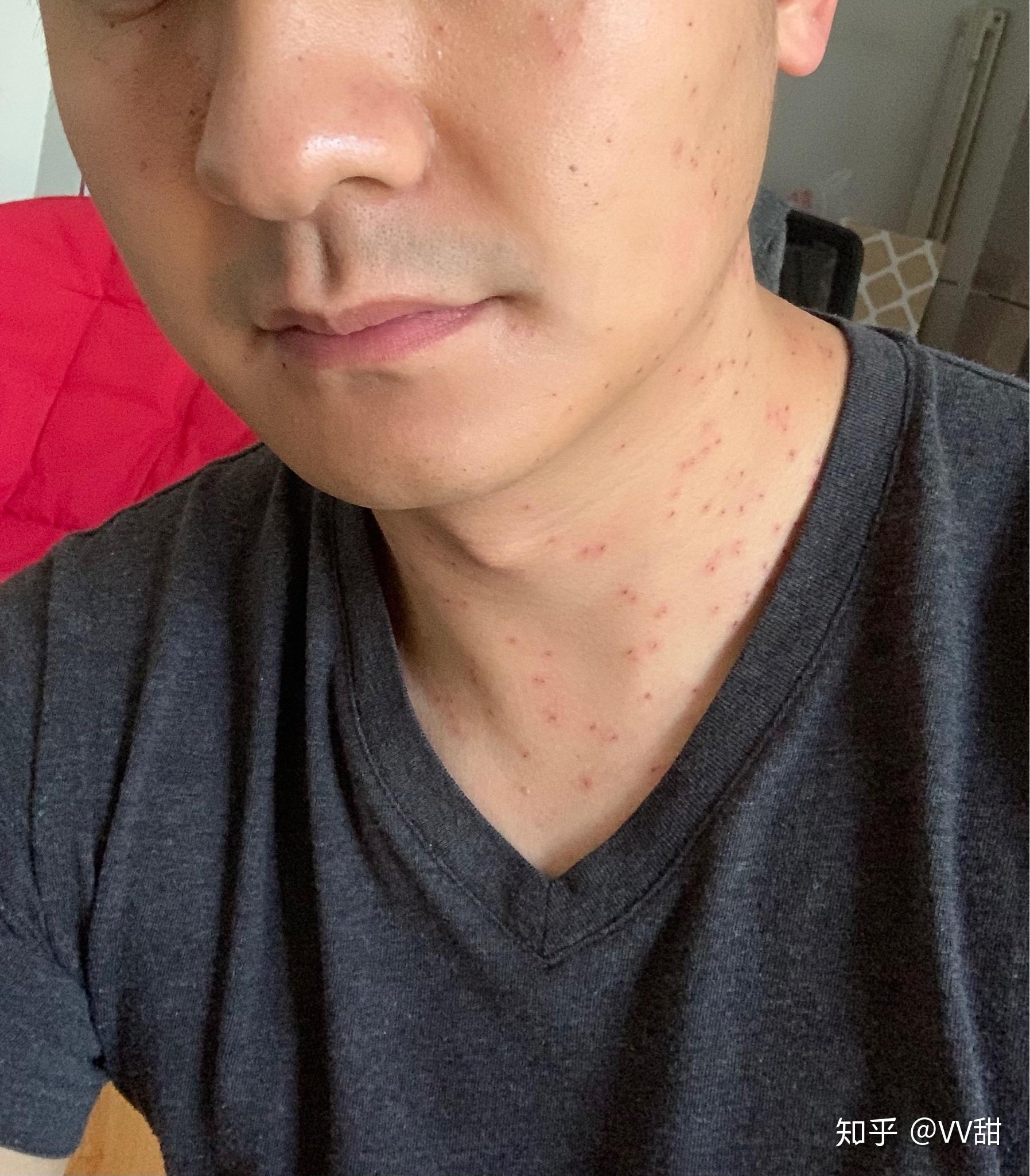 明天再来上图今天看起来好像比第一天红,因为不能碰水,脸已经油光锃亮