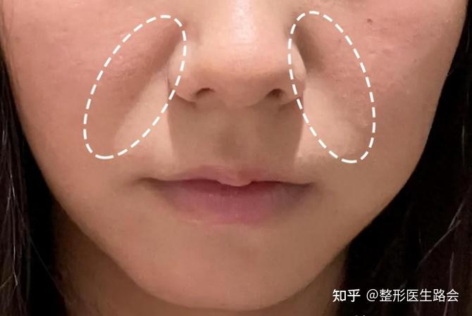 法令纹深显老,纠结做拉皮还是鼻基底填充?这下终于明白了! - 知乎