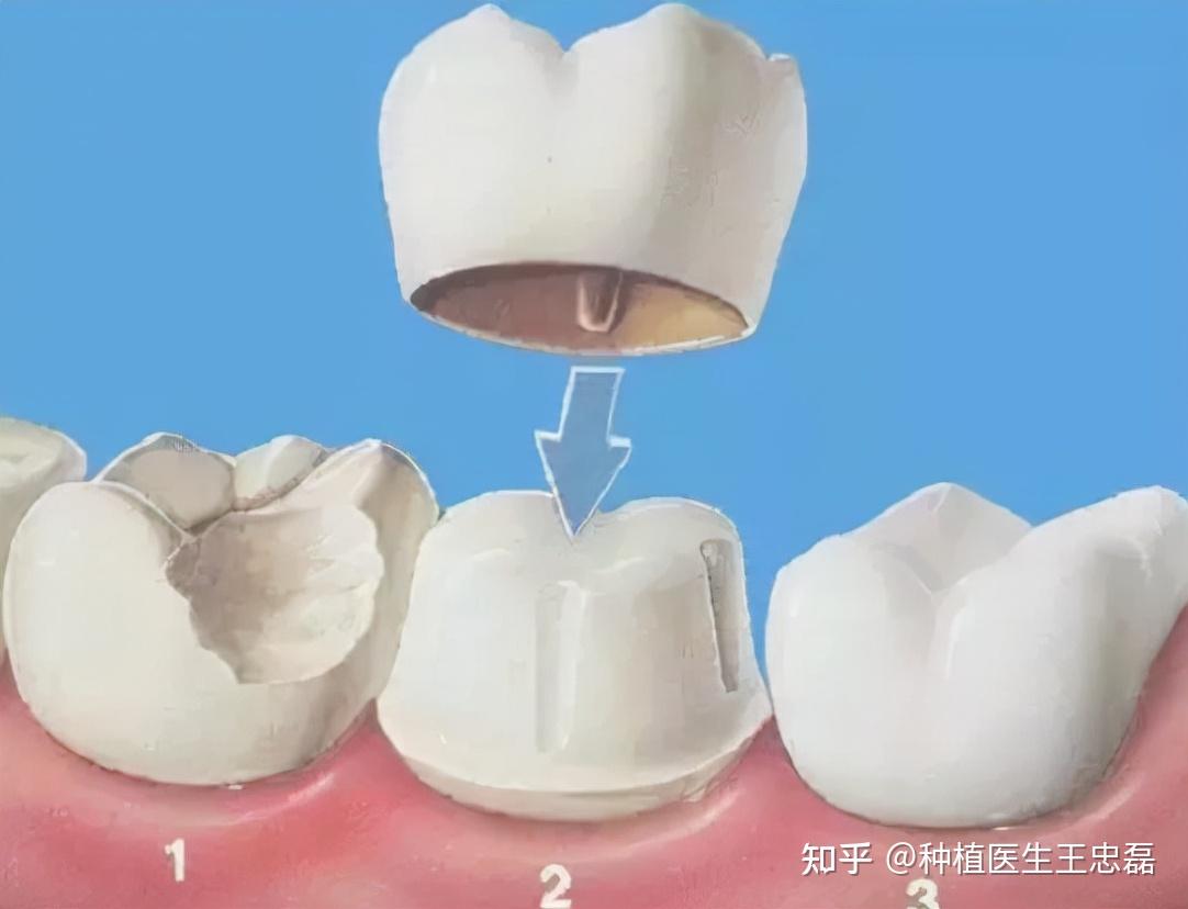 做过根管治疗的后槽牙建议做嵌体还是牙冠？ - 知乎