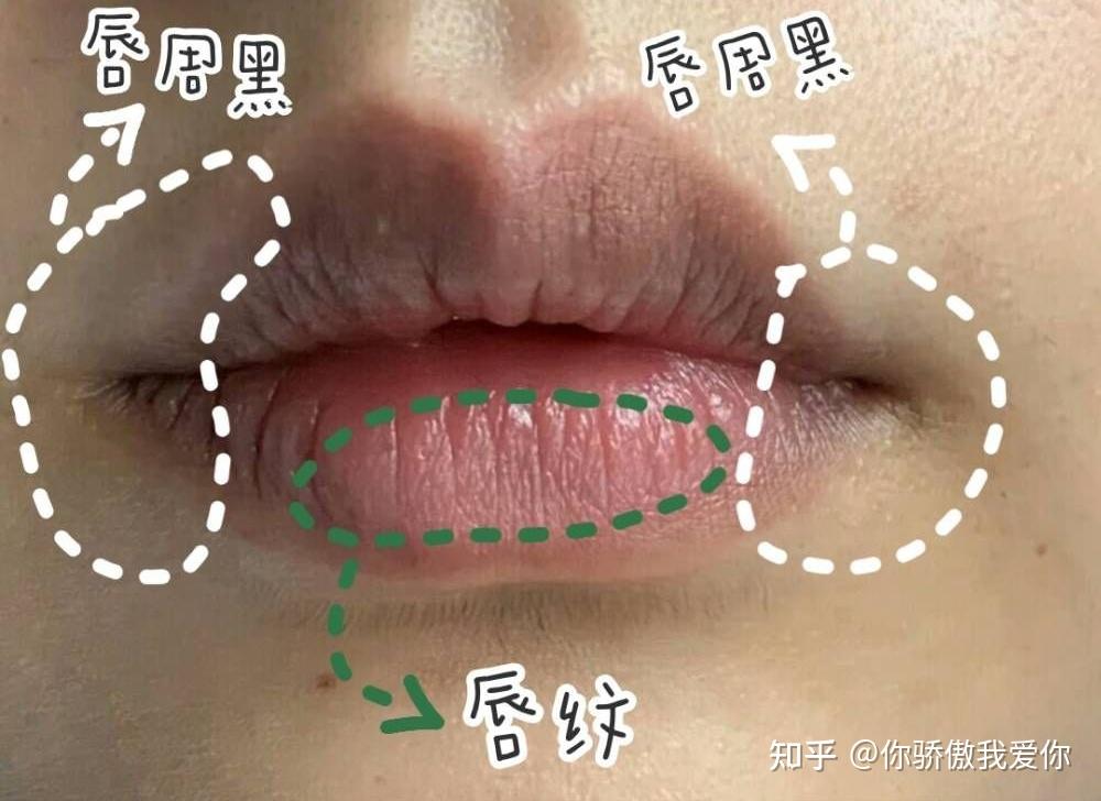 唇周黑色素沉澱不用怕7個小方法一個月告別