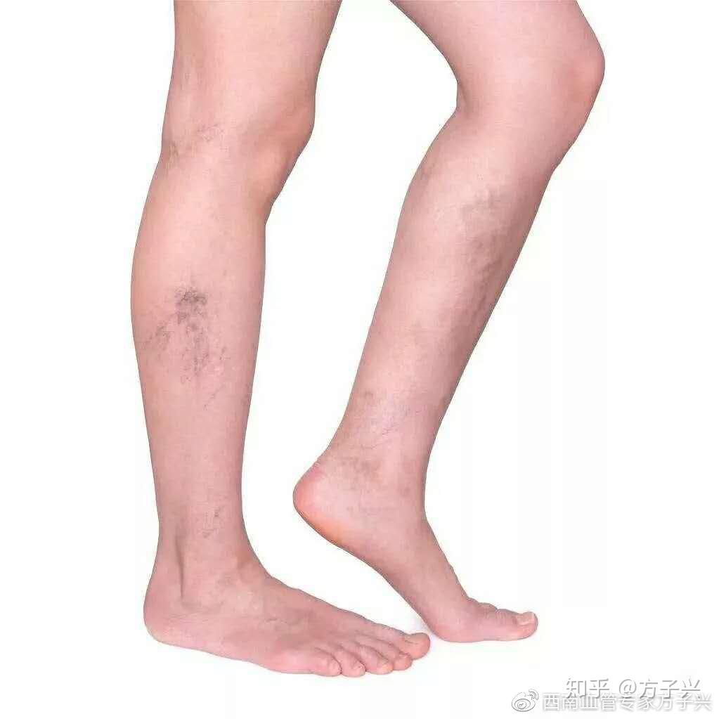 小腿青筋凸起,就像爬满了"小蚯蚓",那么这意味着你已经被静脉曲张缠身