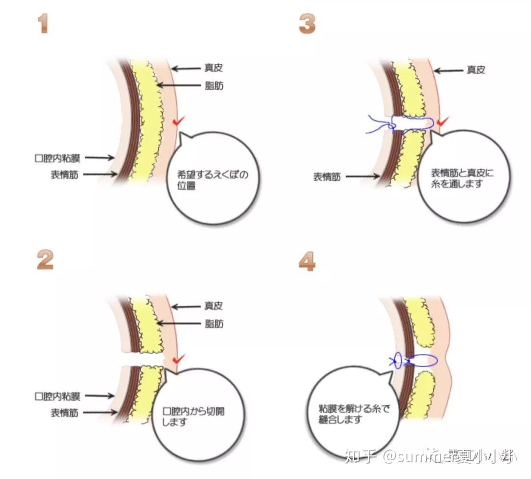 酒窝是面部缺陷?那我也想要怎么办?|日本医美 - 知乎