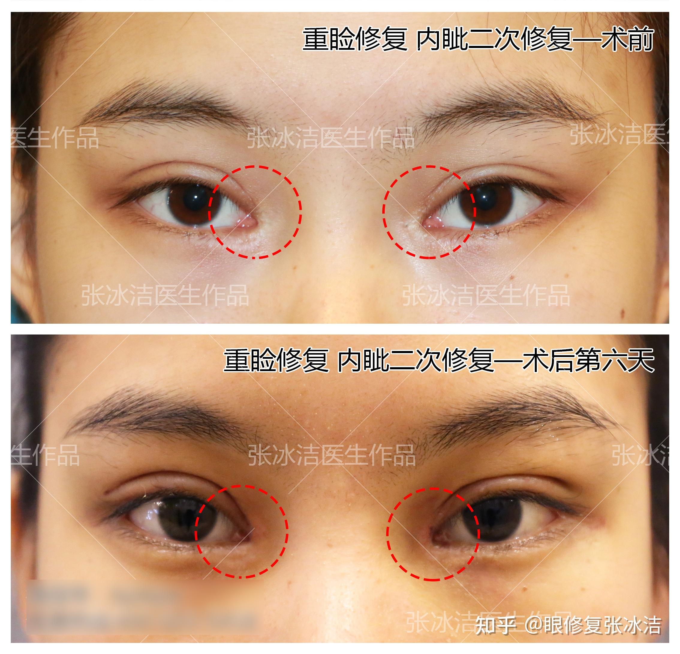 内眼角修复手术方式：V-Y推进皮瓣修复术 - 知乎