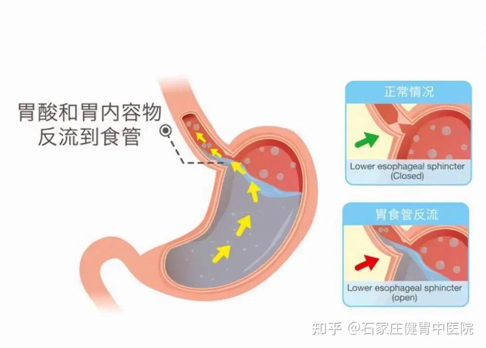 频繁反酸烧心，到底是哪里出了问题？ - 知乎