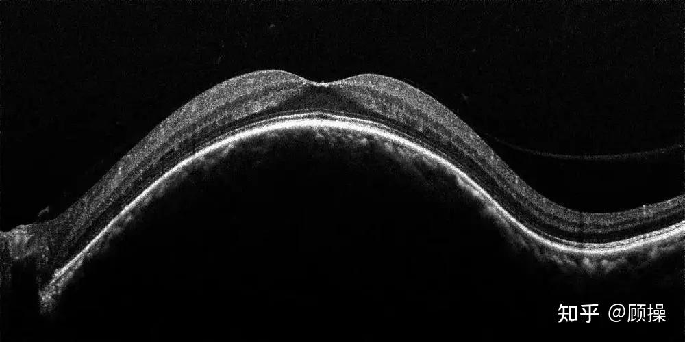 今天讲讲"脉络膜血管瘤"