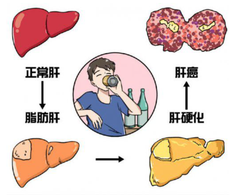 护肝小黄盒易善复多烯磷脂酰胆碱胶囊,保护肝功能健康