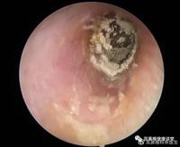 夏季潮湿注意耳内卫生,小心霉菌性外耳道炎.