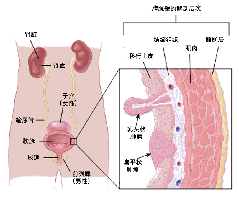 一文读懂膀胱癌的分类 患病风险 筛查和预防 知乎