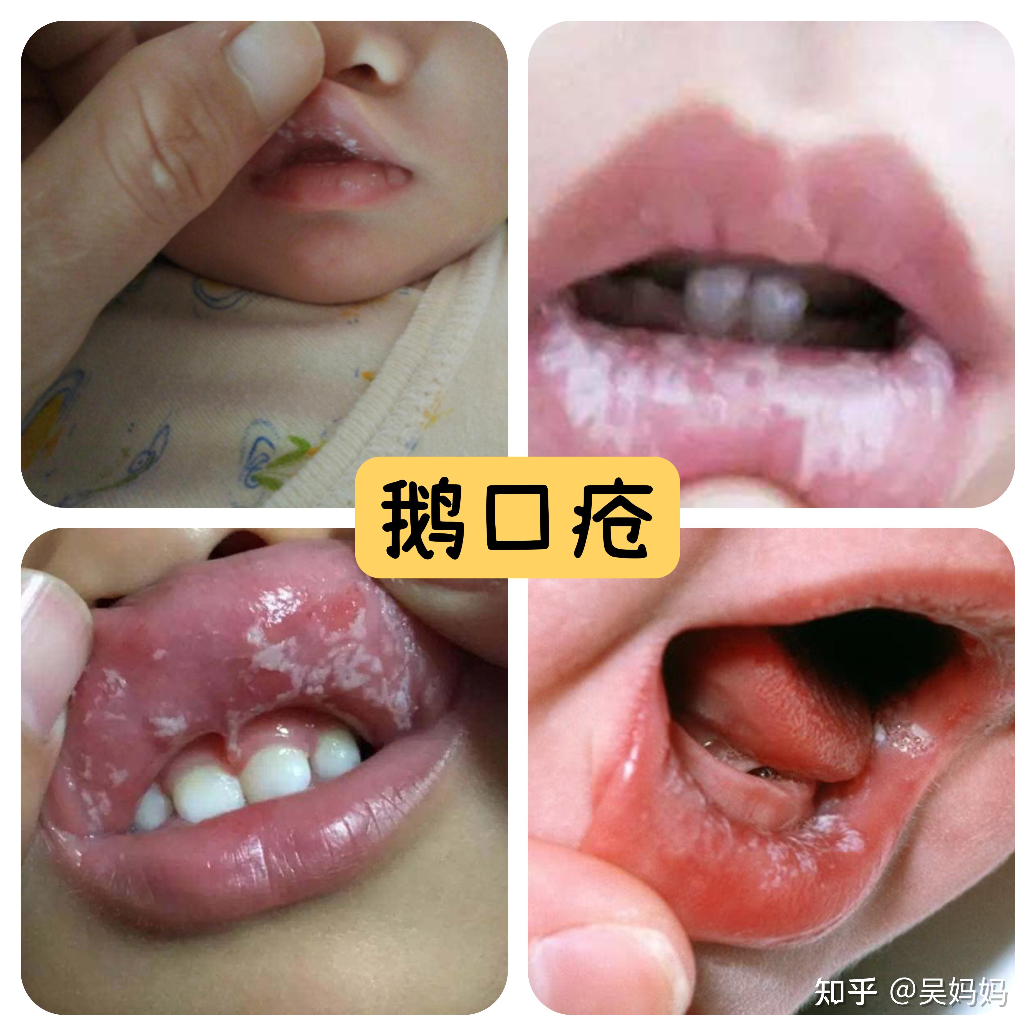 鹅口疮典型症状:口腔黏膜上出现白色乳凝块样物,点状或小片状,逐渐