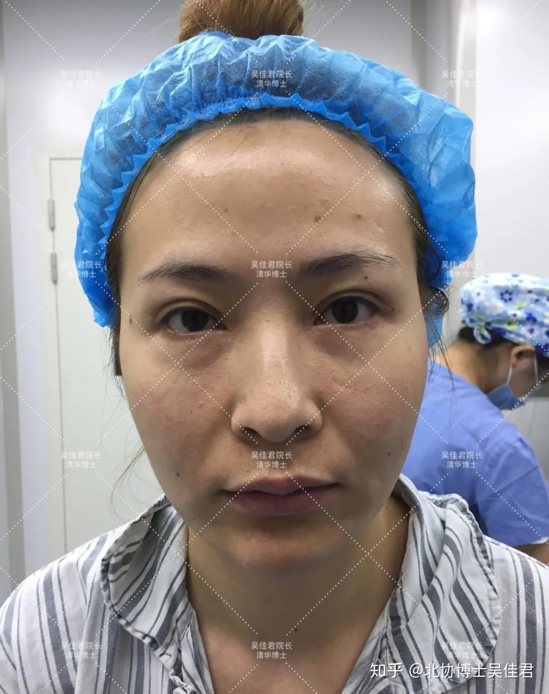 5小时10分“全脸拉皮”，43岁女士大拉皮手术过程，真实细节分享 - 知乎